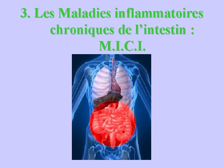 3. Les Maladies inflammatoires chroniques de l’intestin : M. I. C. I. 