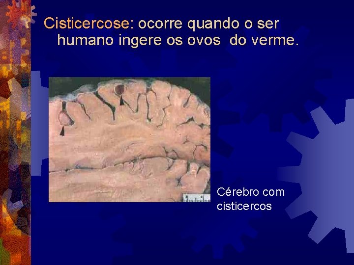 Cisticercose: ocorre quando o ser humano ingere os ovos do verme. Cérebro com cisticercos Cisticercose: ocorre quando o ser humano ingere os ovos do verme. Cérebro com cisticercos