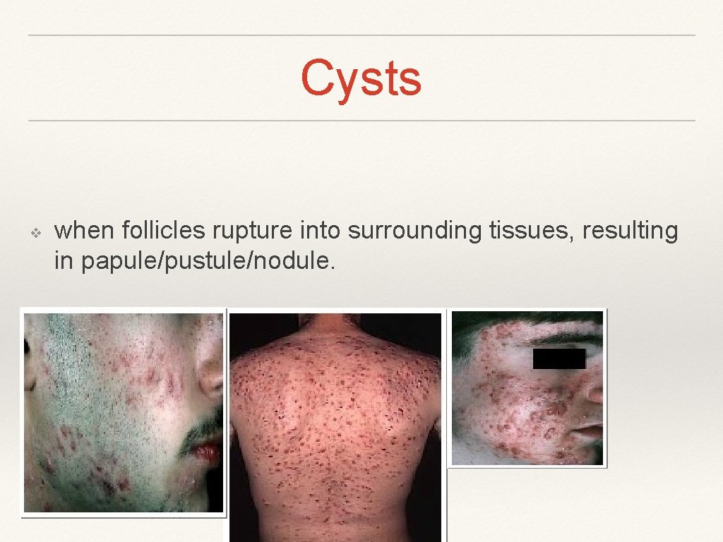 Cysts ❖ when follicles rupture into surrounding tissues, resulting in papule/pustule/nodule. 