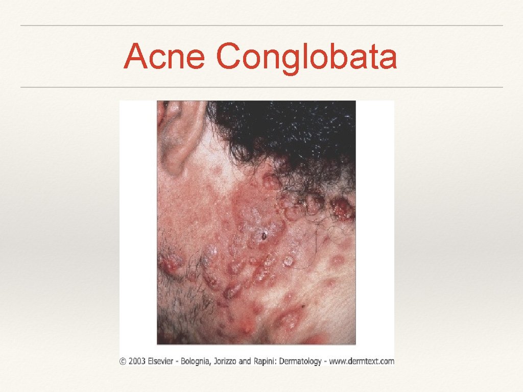 Acne Conglobata 