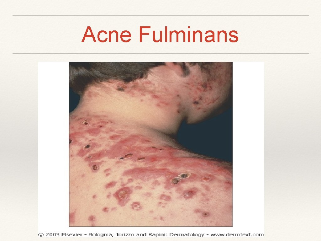 Acne Fulminans 