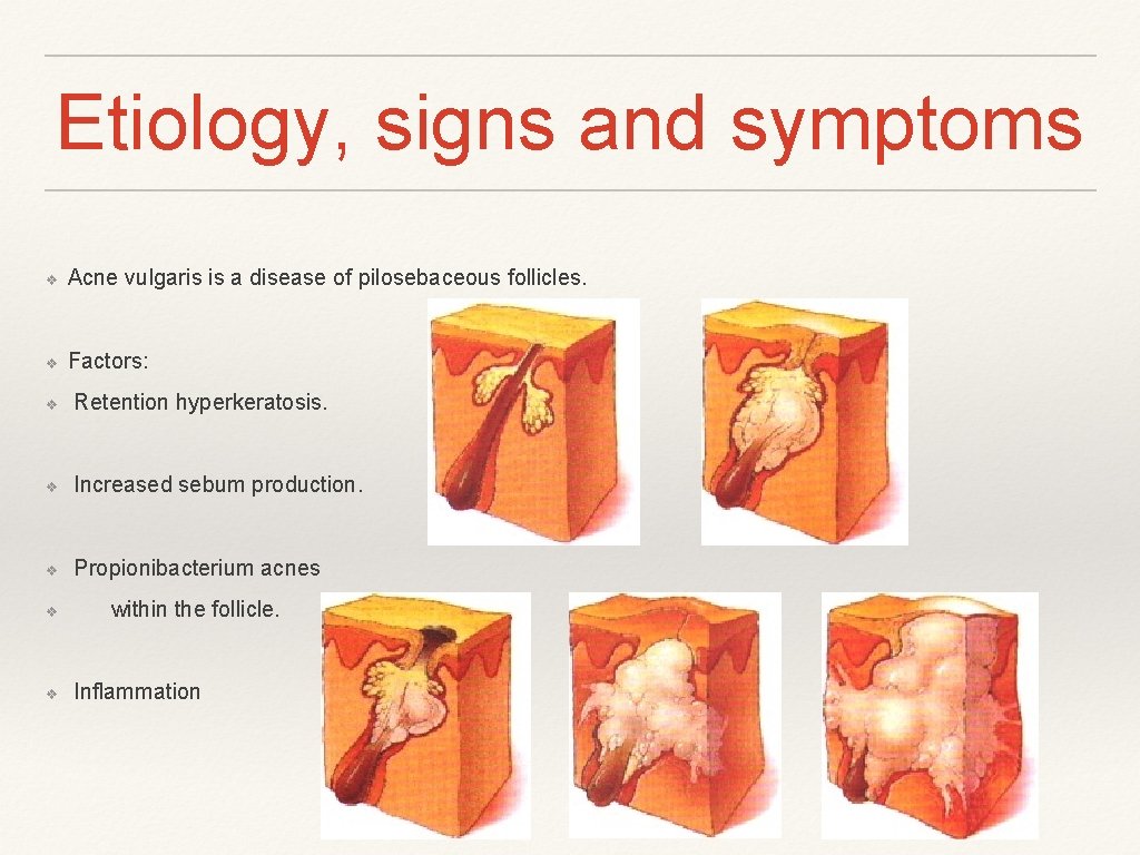 Etiology, signs and symptoms ❖ Acne vulgaris is a disease of pilosebaceous follicles. ❖
