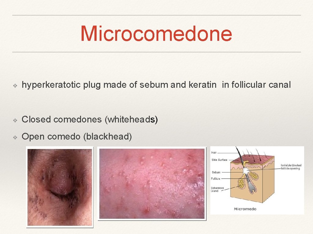 Microcomedone ❖ hyperkeratotic plug made of sebum and keratin in follicular canal ❖ Closed