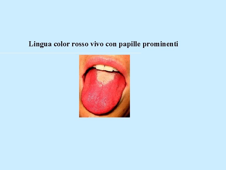 Lingua color rosso vivo con papille prominenti 