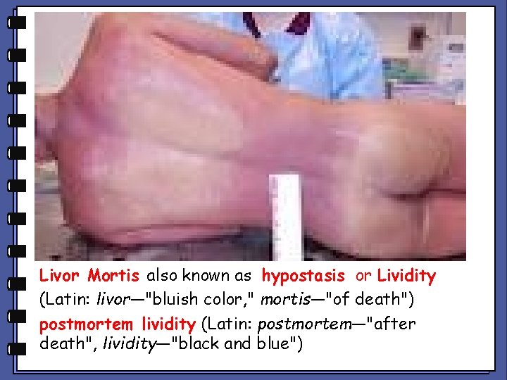 Livor Mortis also known as hypostasis or Lividity (Latin: livor—"bluish color, " mortis—"of death")