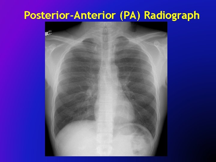 Posterior-Anterior (PA) Radiograph 