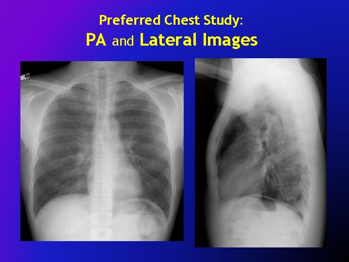 Preferred Chest Study: PA and Lateral Images 