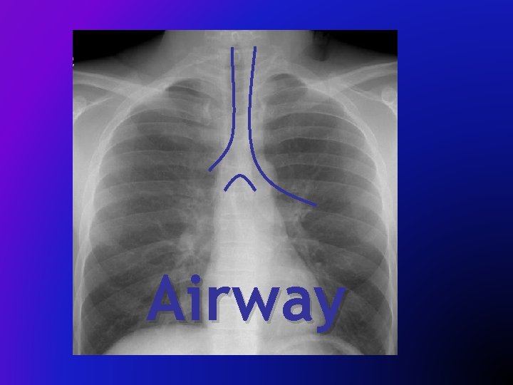 Airway 