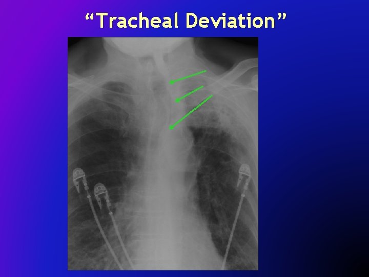 “Tracheal Deviation” 