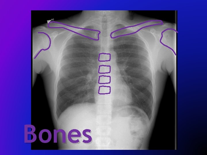 Bones 