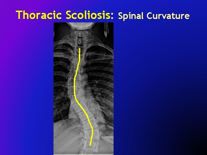 Thoracic Scoliosis: Spinal Curvature 