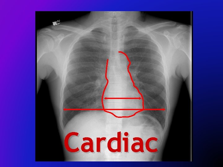 Cardiac 