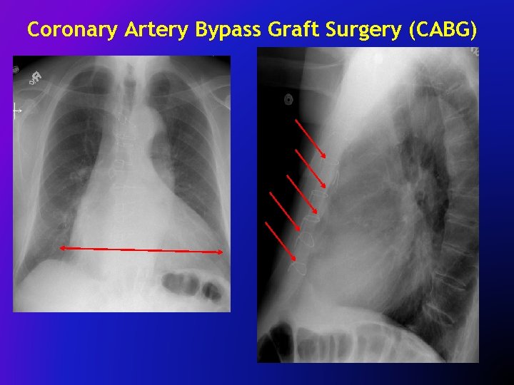 Coronary Artery Bypass Graft Surgery (CABG) 