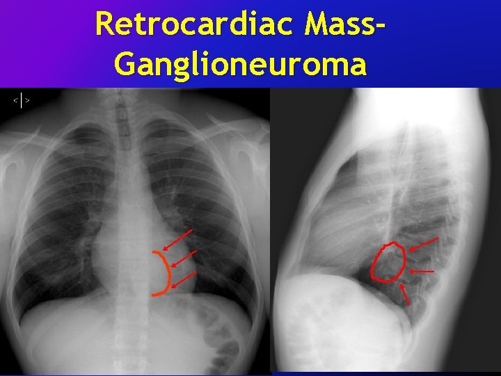 Retrocardiac Mass. Ganglioneuroma 