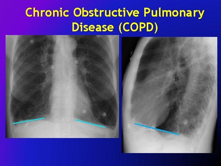 Chronic Obstructive Pulmonary Disease (COPD) 