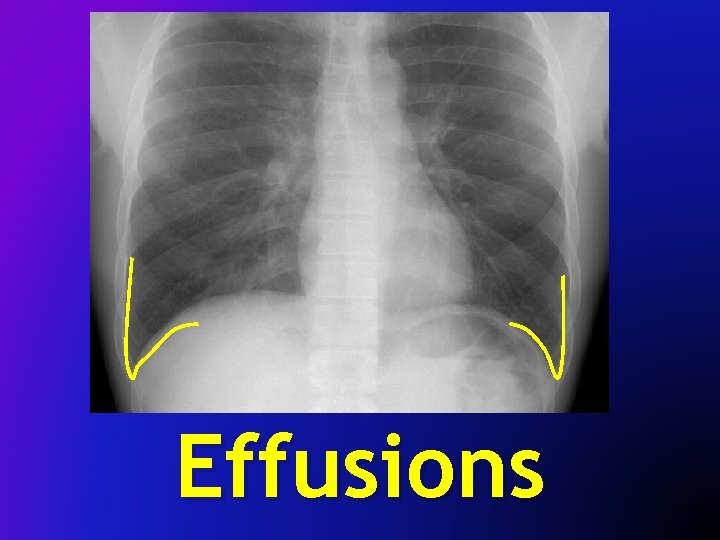 Effusions 