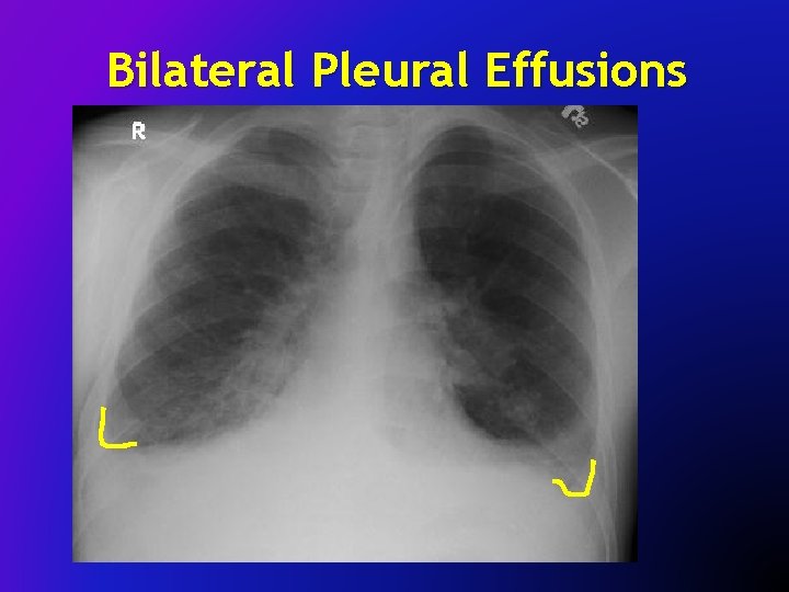 Bilateral Pleural Effusions 