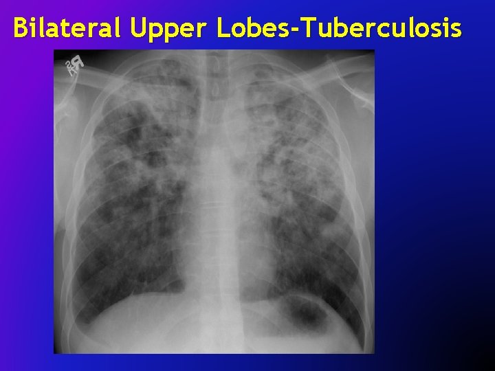 Bilateral Upper Lobes-Tuberculosis 