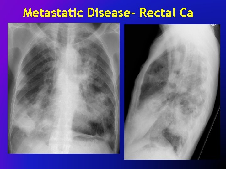 Metastatic Disease- Rectal Ca 