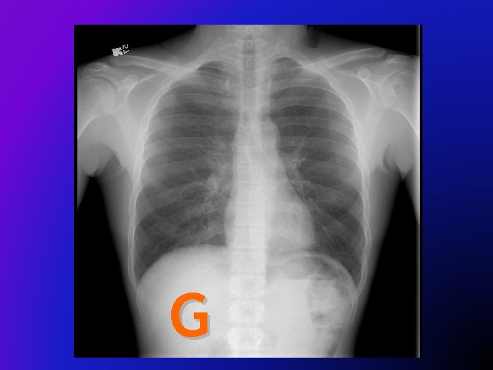 G 