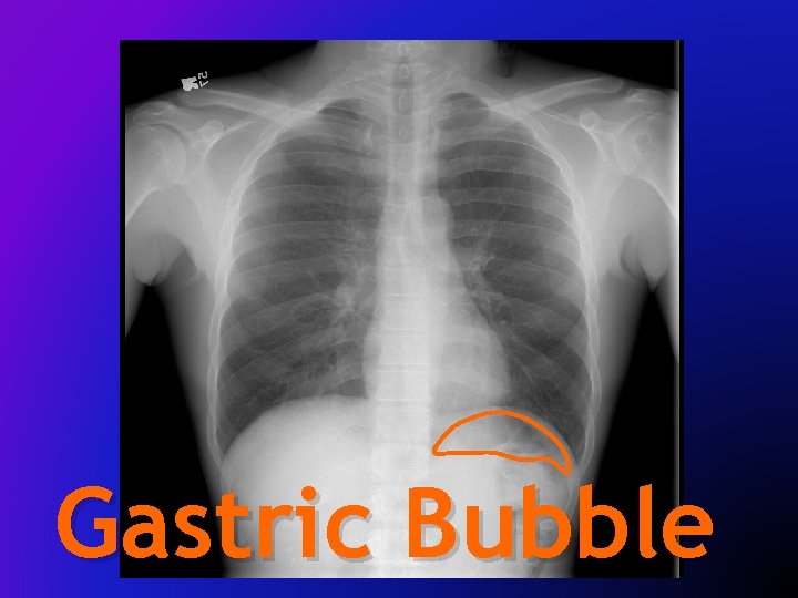 Gastric Bubble 