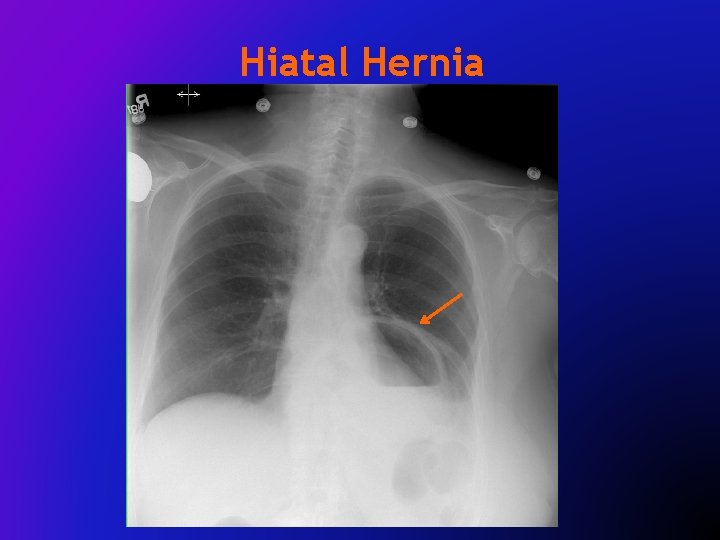 Hiatal Hernia 