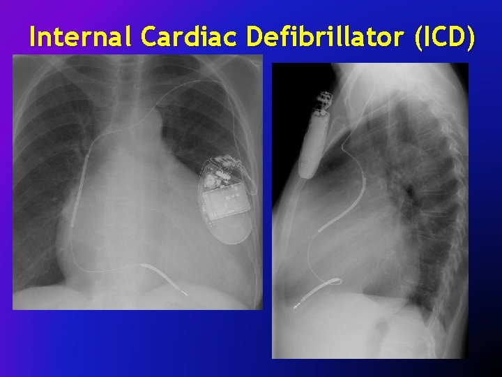 Internal Cardiac Defibrillator (ICD) 