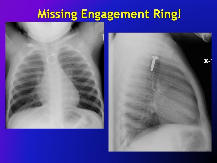 Missing Engagement Ring! 