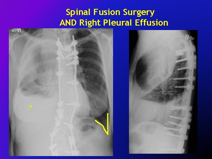 Spinal Fusion Surgery AND Right Pleural Effusion Effusio ? 