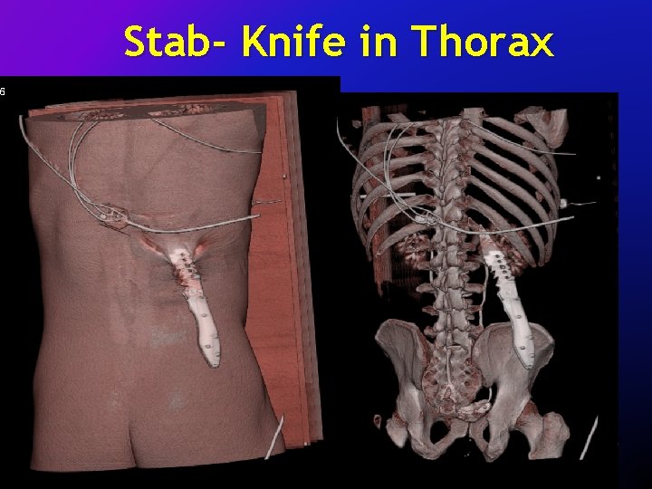 Stab- Knife in Thorax 