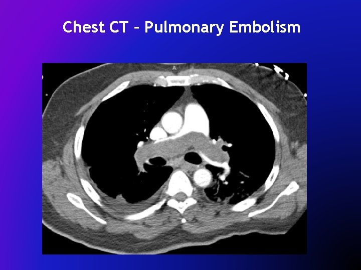 Chest CT – Pulmonary Embolism 