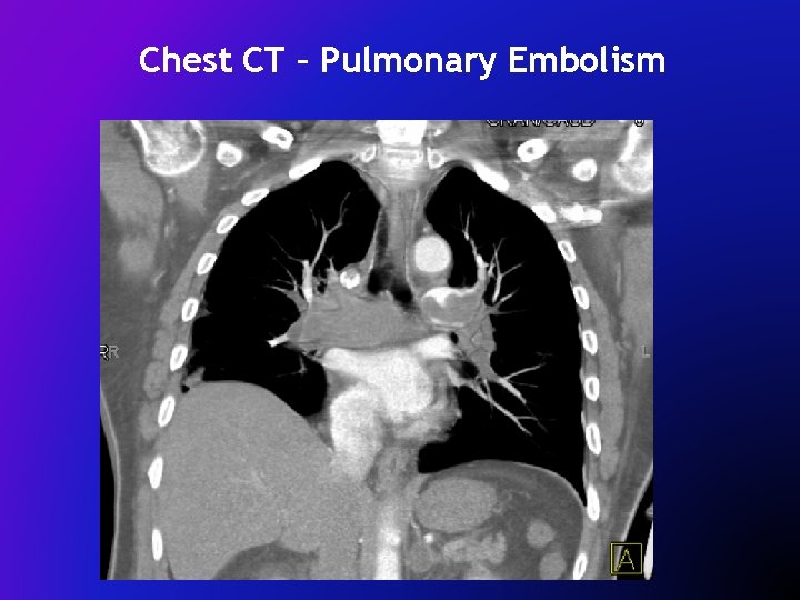 Chest CT – Pulmonary Embolism 