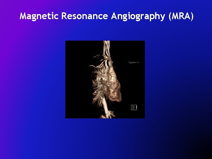 Magnetic Resonance Angiography (MRA) 