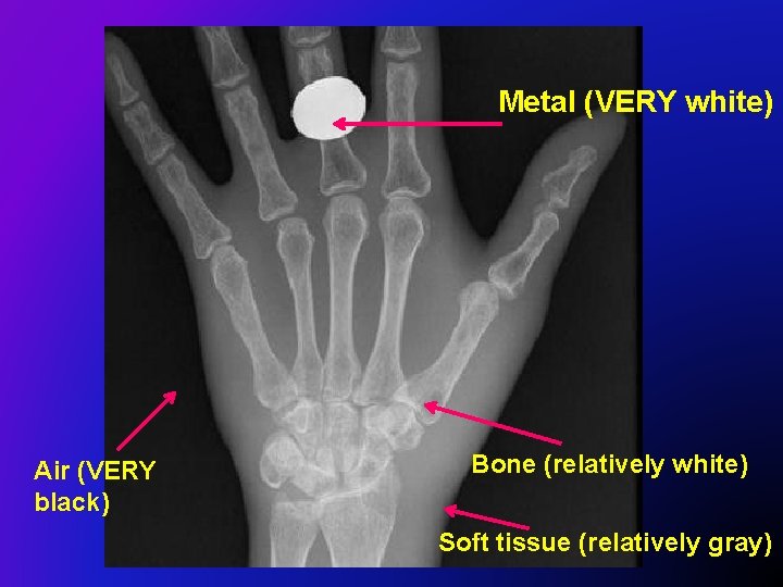 Metal (VERY white) Air (VERY black) Bone (relatively white) Soft tissue (relatively gray) 