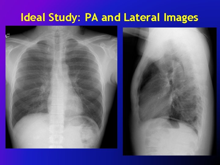 Ideal Study: PA and Lateral Images 