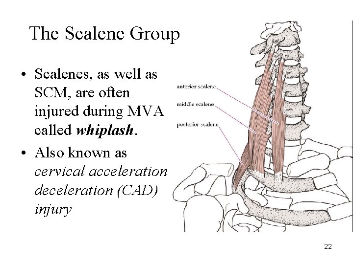 The Scalene Group • Scalenes, as well as SCM, are often injured during MVA