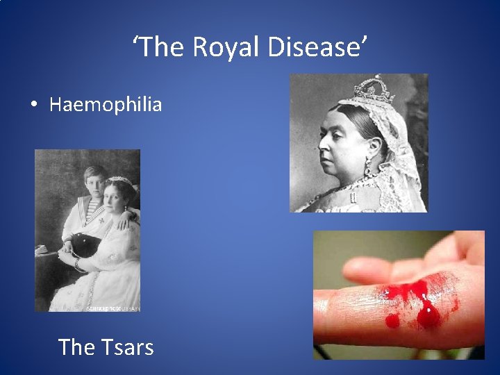 ‘The Royal Disease’ • Haemophilia The Tsars 