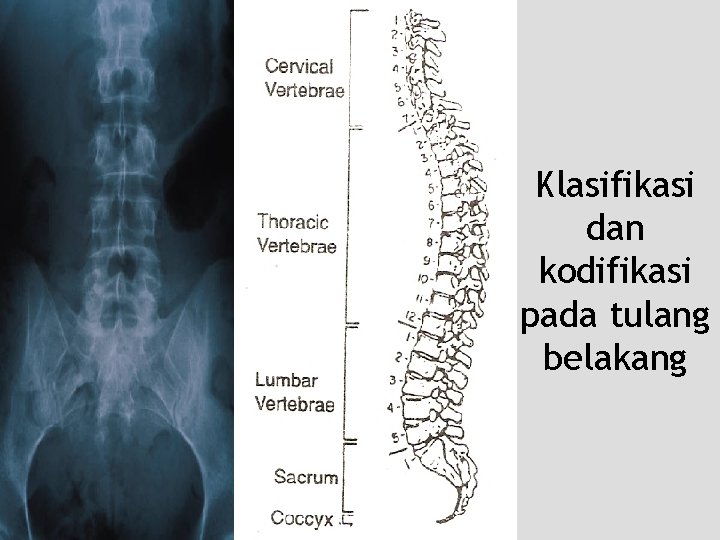 Klasifikasi dan kodifikasi pada tulang belakang 