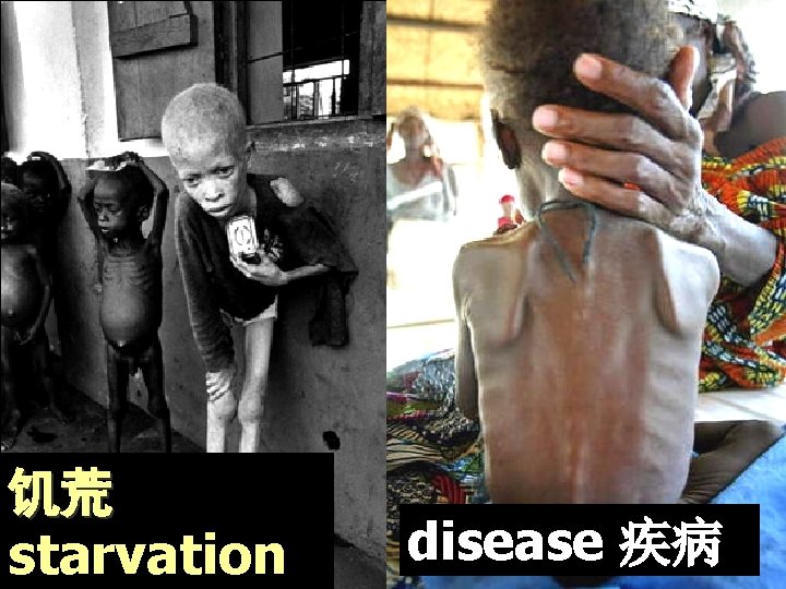 饥荒 starvation disease 疾病 饥荒 starvation disease 疾病