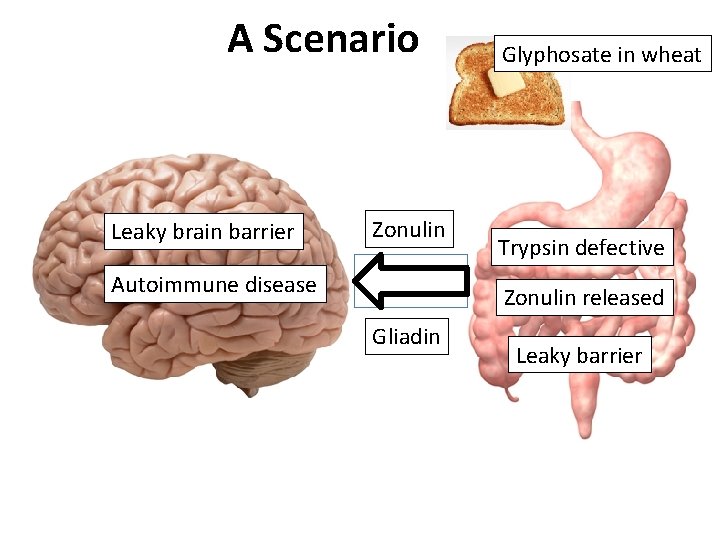 A Scenario Leaky brain barrier Zonulin Autoimmune disease Glyphosate in wheat Trypsin defective Zonulin