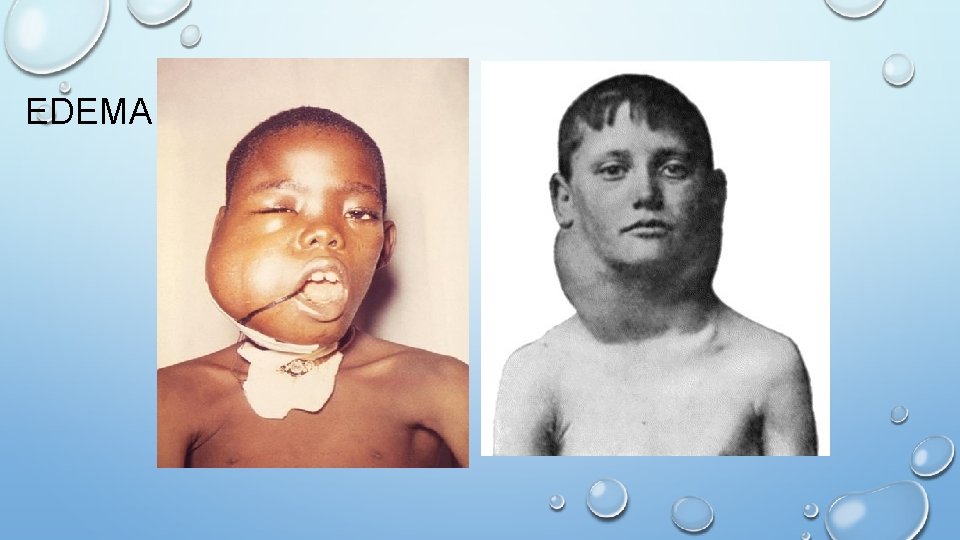 EDEMA 
