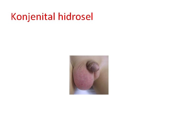 Konjenital hidrosel 