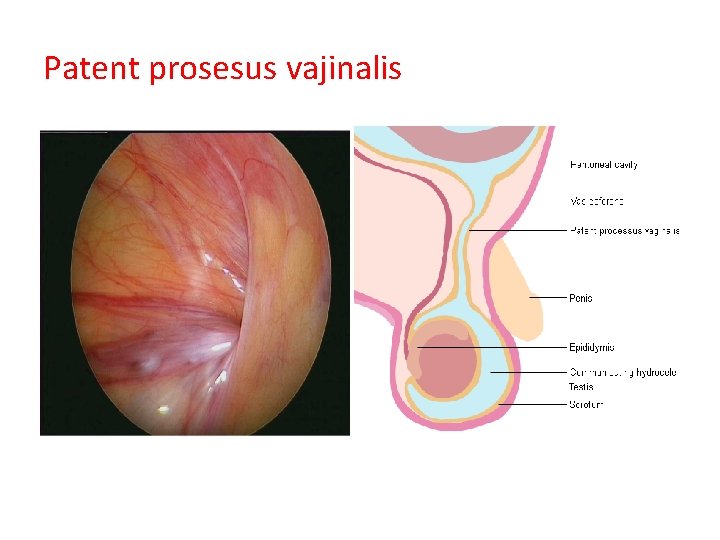 Patent prosesus vajinalis 