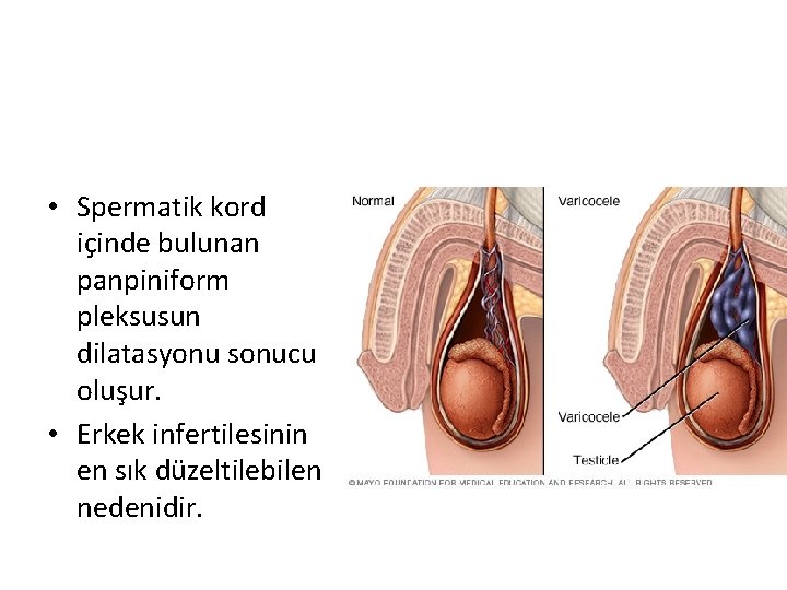 • Spermatik kord içinde bulunan panpiniform pleksusun dilatasyonu sonucu oluşur. • Erkek infertilesinin