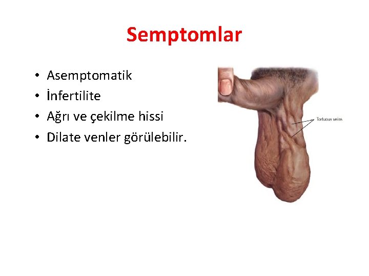 Semptomlar • • Asemptomatik İnfertilite Ağrı ve çekilme hissi Dilate venler görülebilir. 