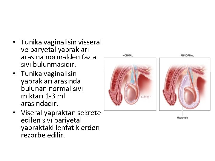  • Tunika vaginalisin visseral ve paryetal yaprakları arasına normalden fazla sıvı bulunmasıdır. •