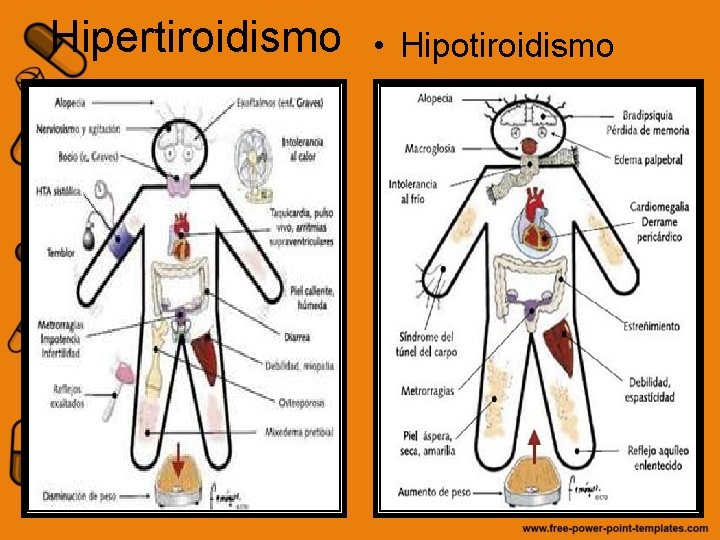 Hipertiroidismo • Hipotiroidismo 