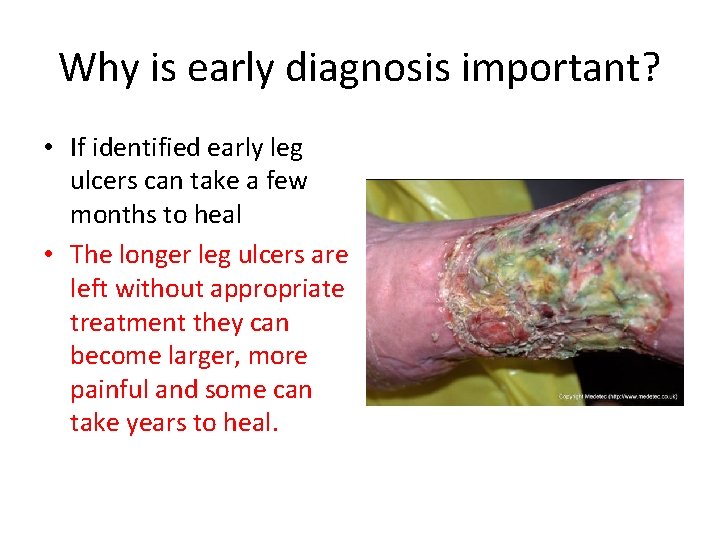 Why is early diagnosis important? • If identified early leg ulcers can take a