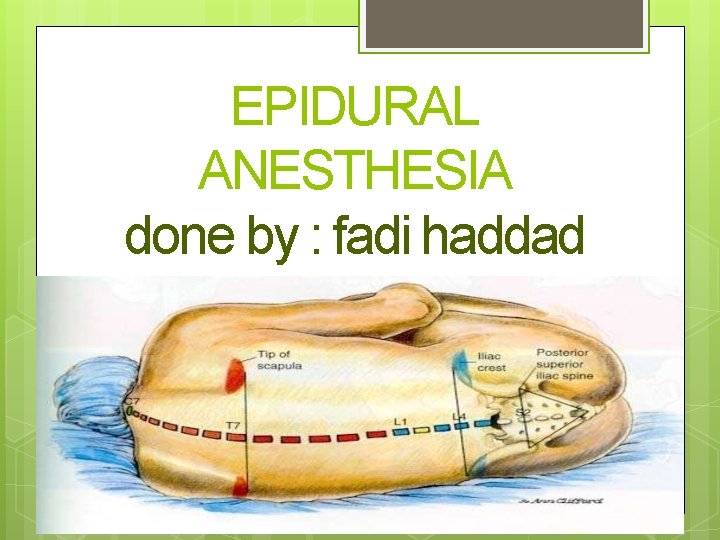 EPIDURAL ANESTHESIA done by : fadi haddad 