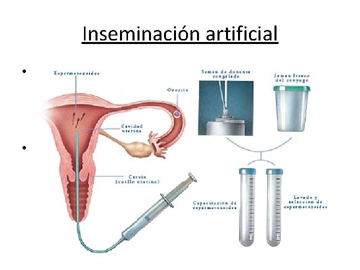 Inseminación artificial • La Inseminacion Artificial es un procedimiento de fertilización en el que Inseminación artificial • La Inseminacion Artificial es un procedimiento de fertilización en el que